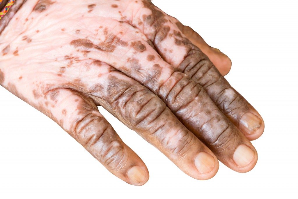 Hands affected with autoimmune disease