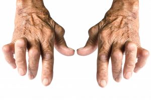 hand with rheumatoid arthritis