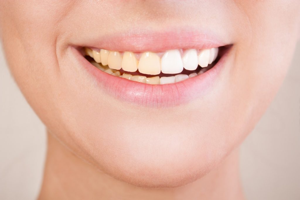 woman's complete set of white teeth