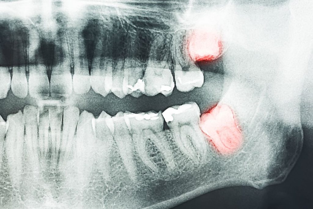 x-ray mouth