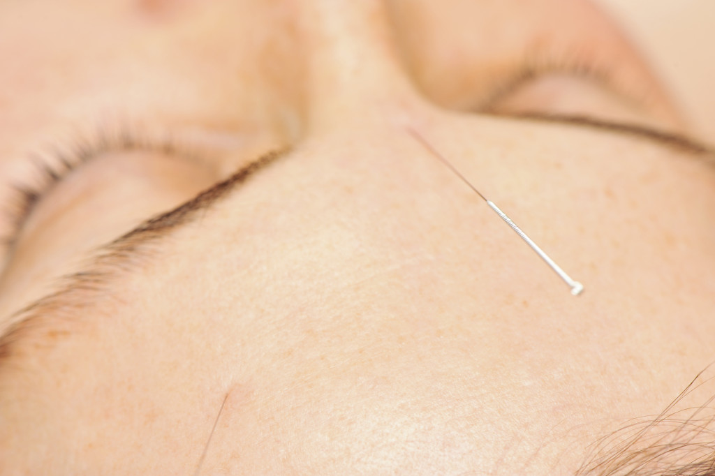 woman with acupuncture needles
