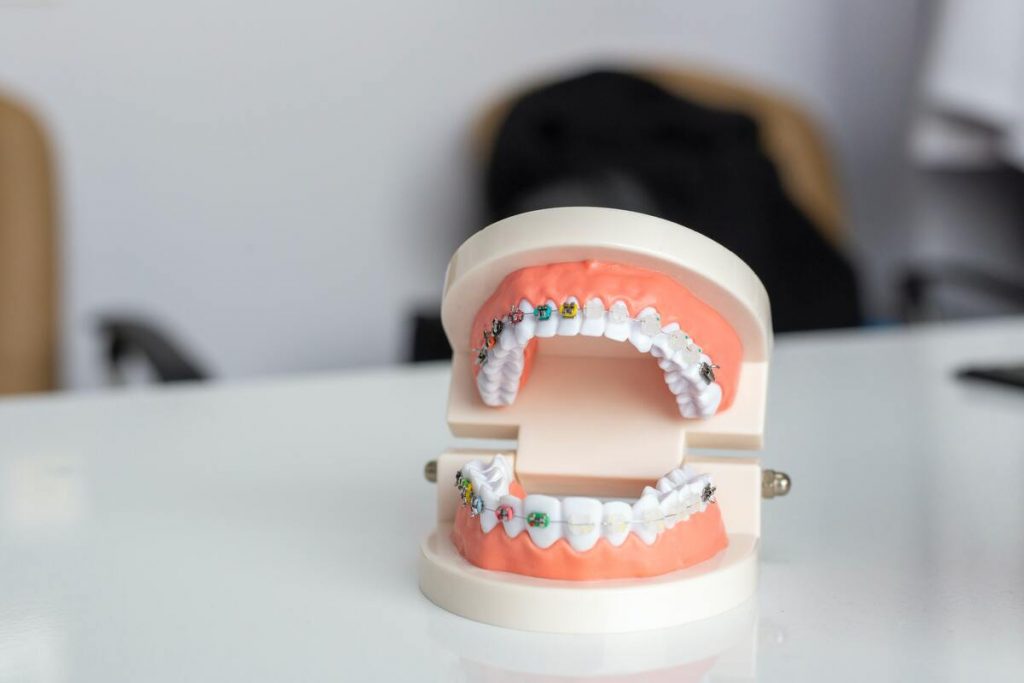 braces on a model teeth