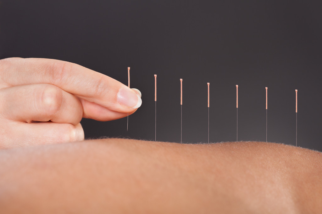 person doing acupuncture 