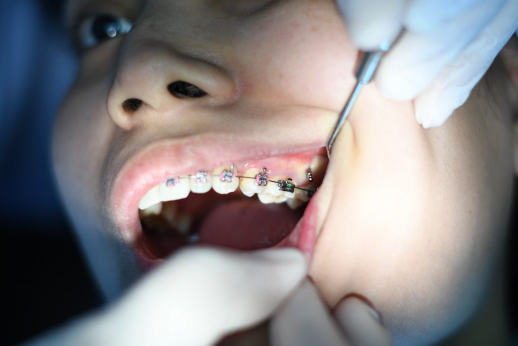 woman braces checkup