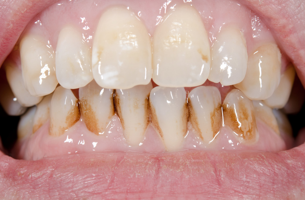 A teeth turning yellow due to sugar