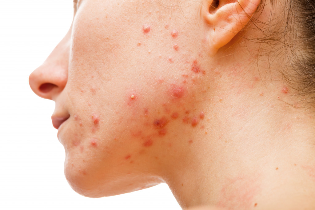 A woman dealing with acne on her jawline