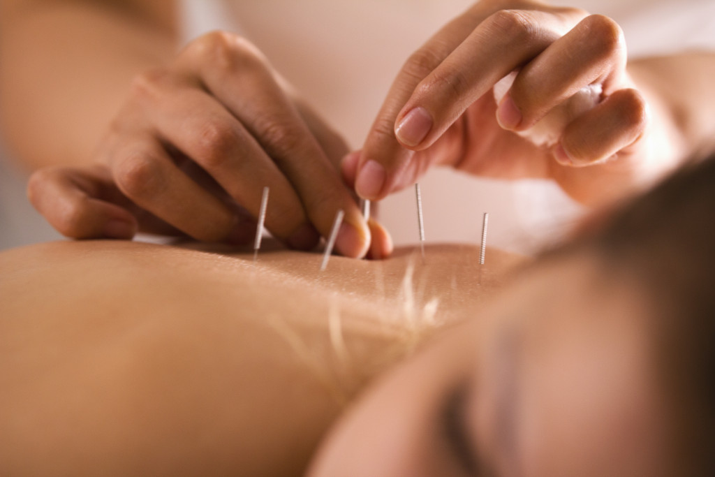 A close up of acupuncture needles being inserted into the skin by a practitioner
